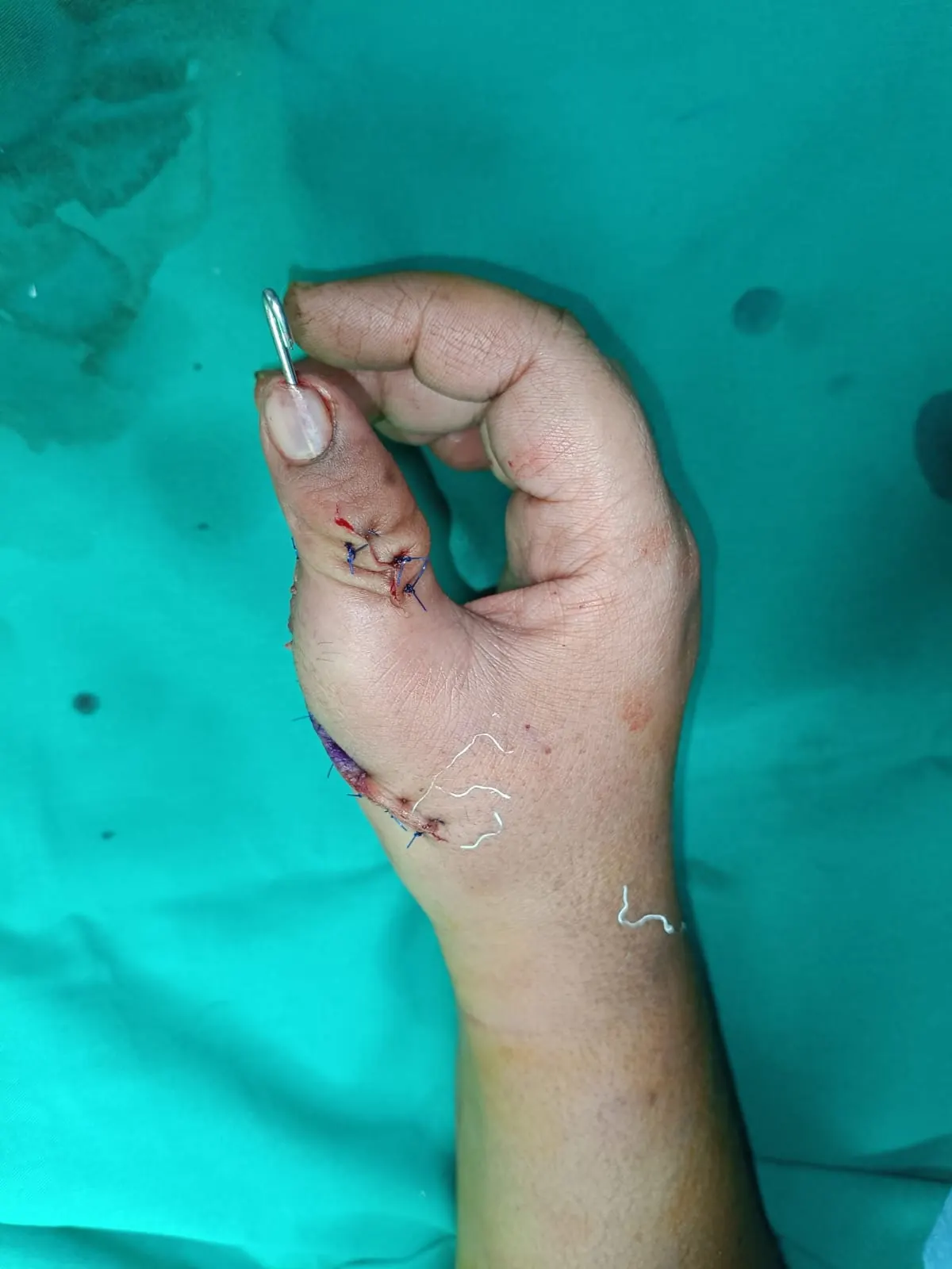 Hand Surgery — after surgery result by Dr. Muhammad Ali in Lahore