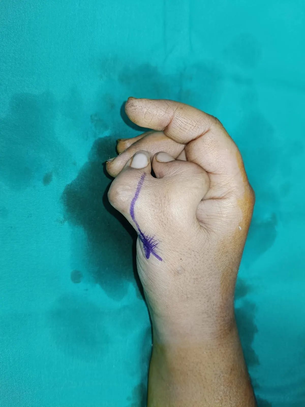 Hand Surgery — before surgery, patient of Dr. Muhammad Ali in Lahore