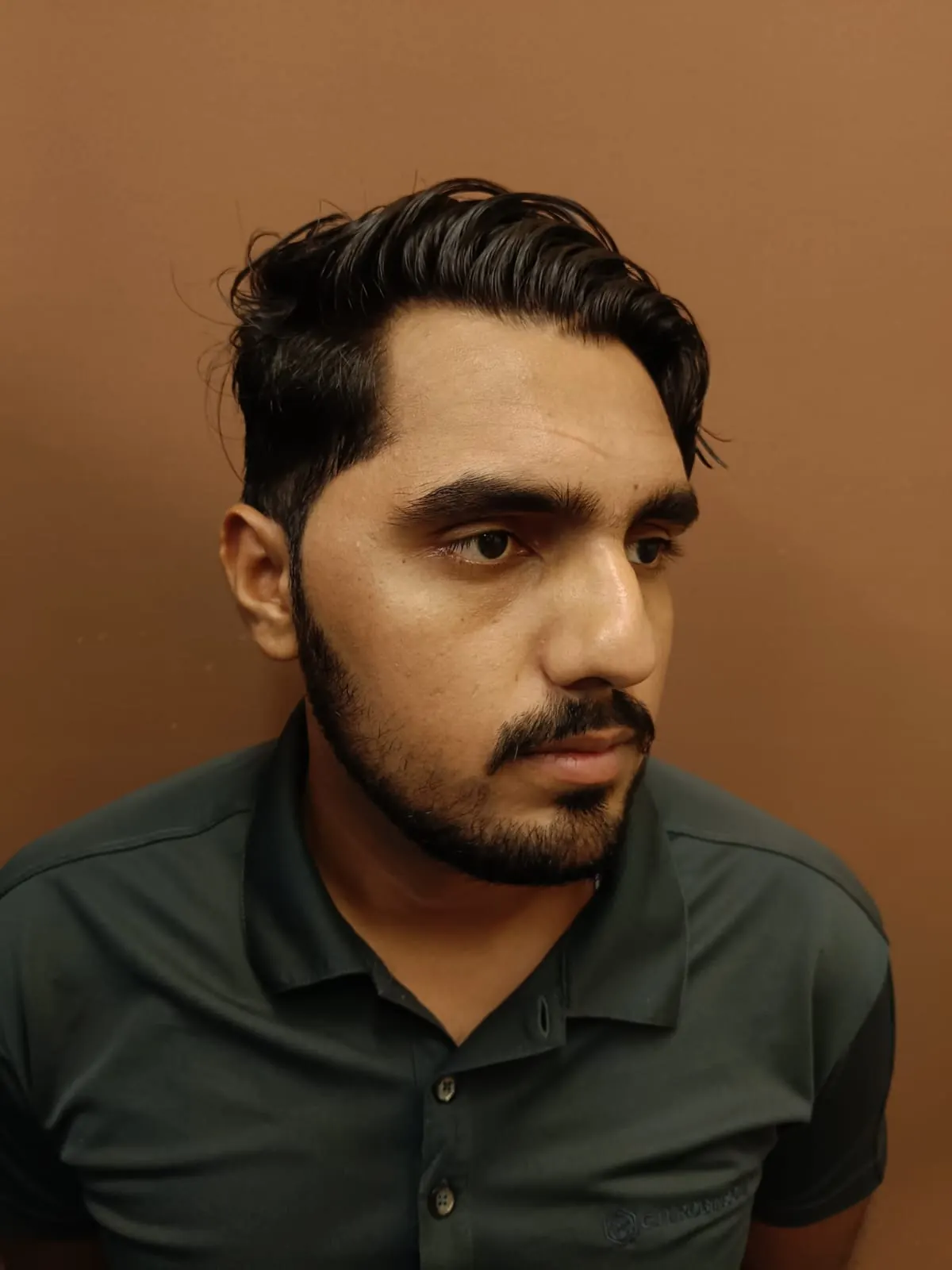 Rhinoplasty — related procedure offered by Dr. Muhammad Ali in Lahore