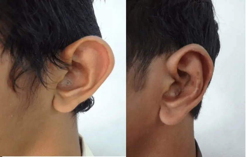 Otoplasty performed by Dr. Muhammad Ali, plastic surgeon in Lahore